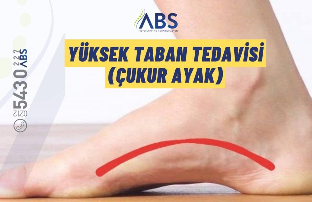Yüksek Taban Tedavisi (Çukur Ayak)