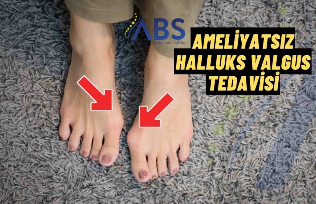 Ameliyatsız Halluks Valgus Tedavisi