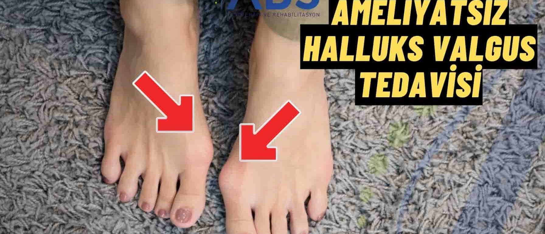 Ameliyatsız Halluks Valgus Tedavisi