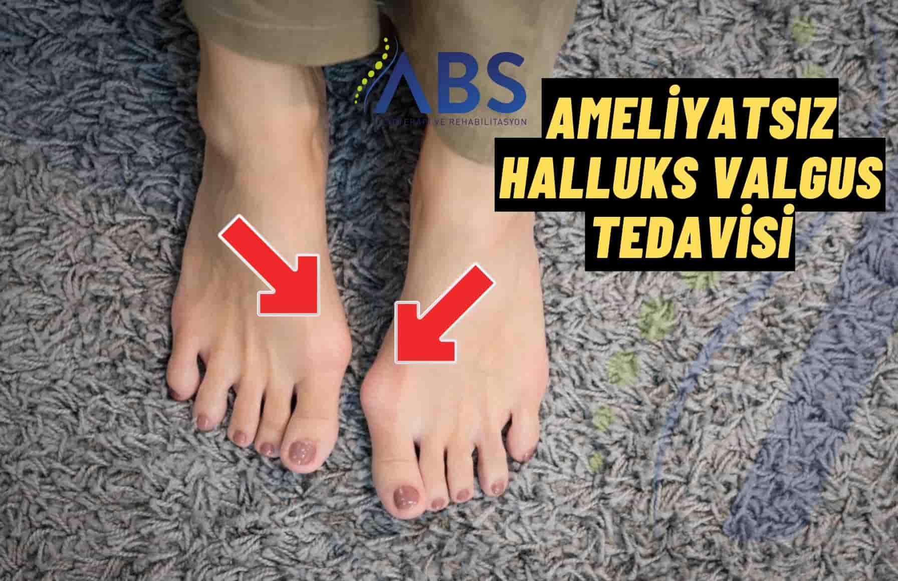 Ameliyatsız Halluks Valgus Tedavisi