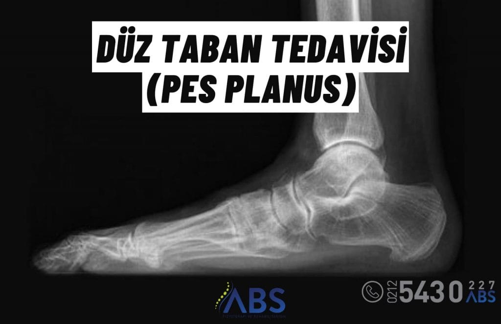 Düz Taban Tedavisi (Pes Planus)