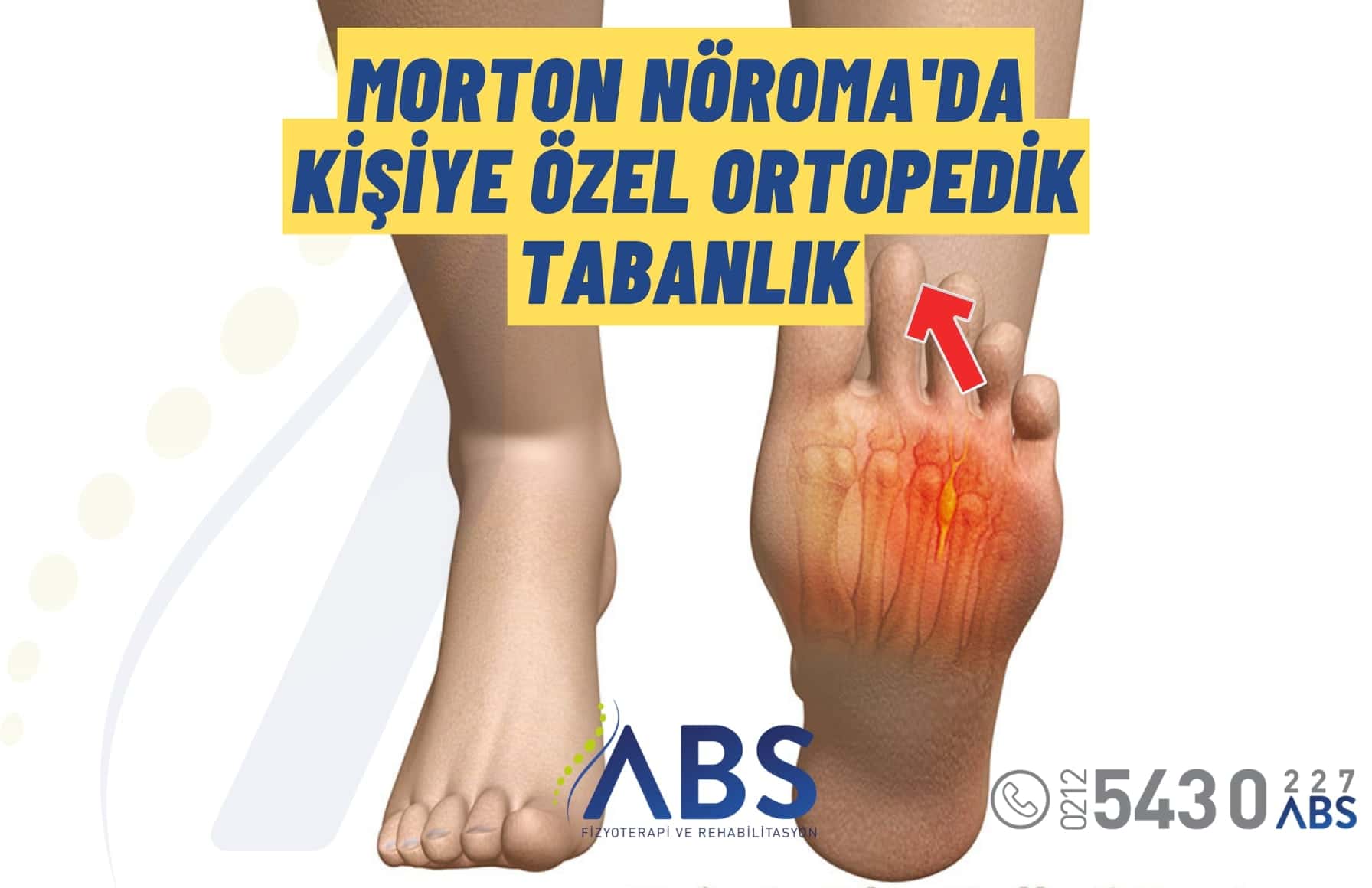 Morton Nöroma İçin Tabanlık