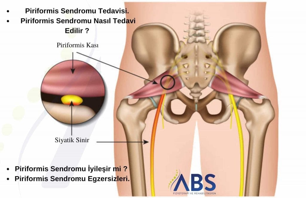 piriformis sendromu tedavisi