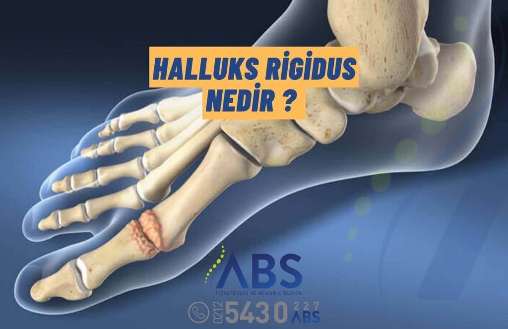 Halluks Rigidus Nedir