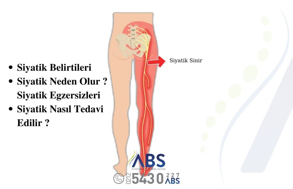 Siyatik Tedavisi