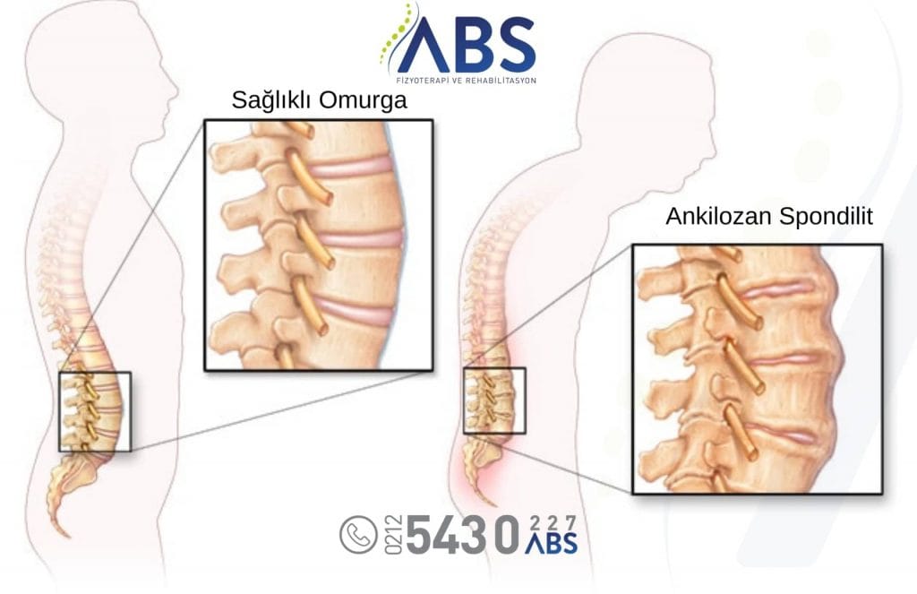 Ankilozan Spondilit Tedavisi