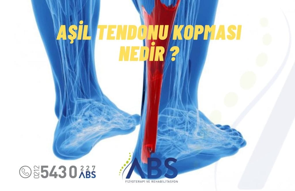 Aşil tendonu kopması