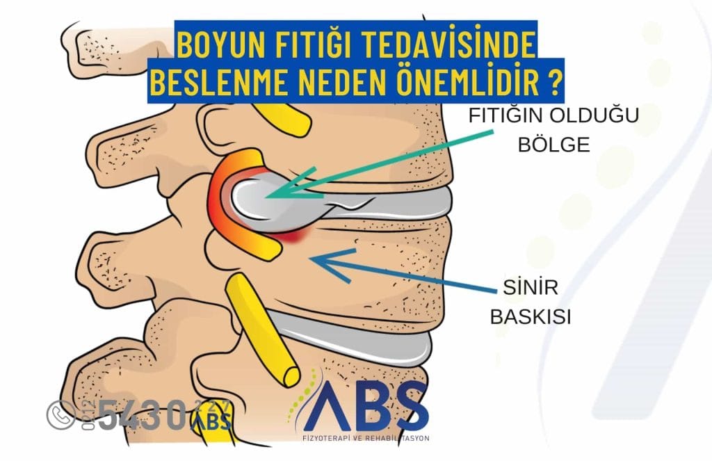 boyun fıtığı tedavisinde beslenme