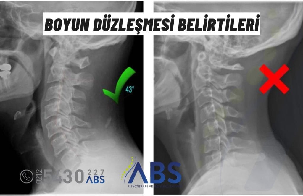 Boyun Düzleşmesi Belirtisi