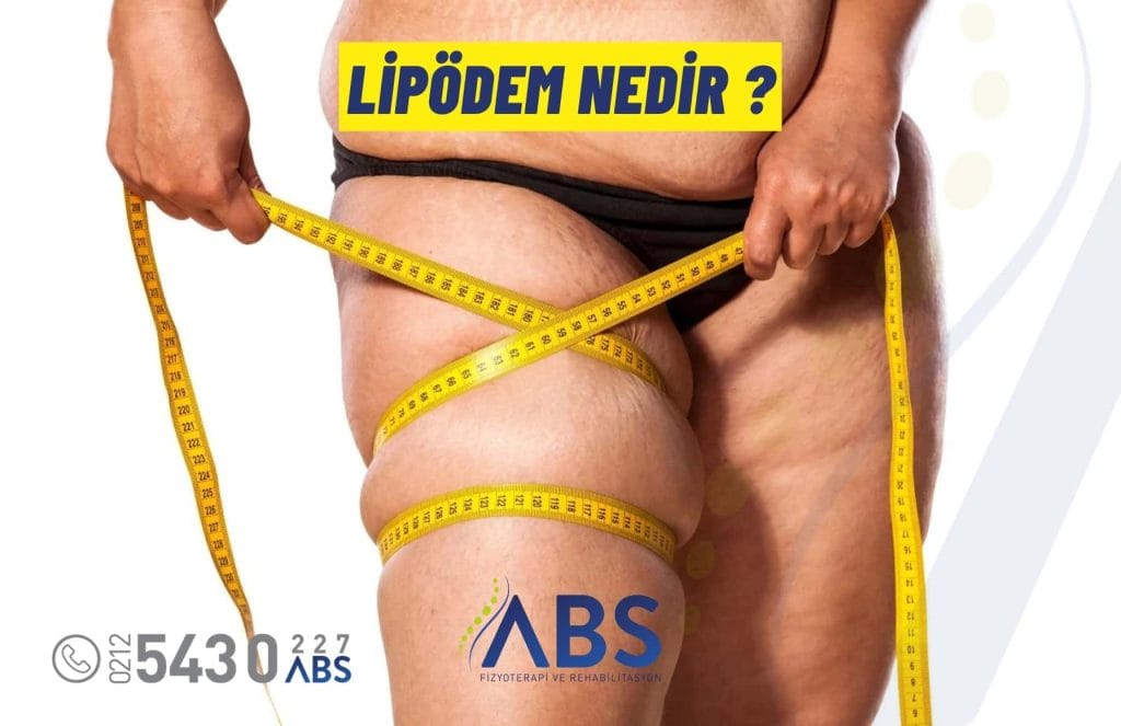 Lipödem Nedir