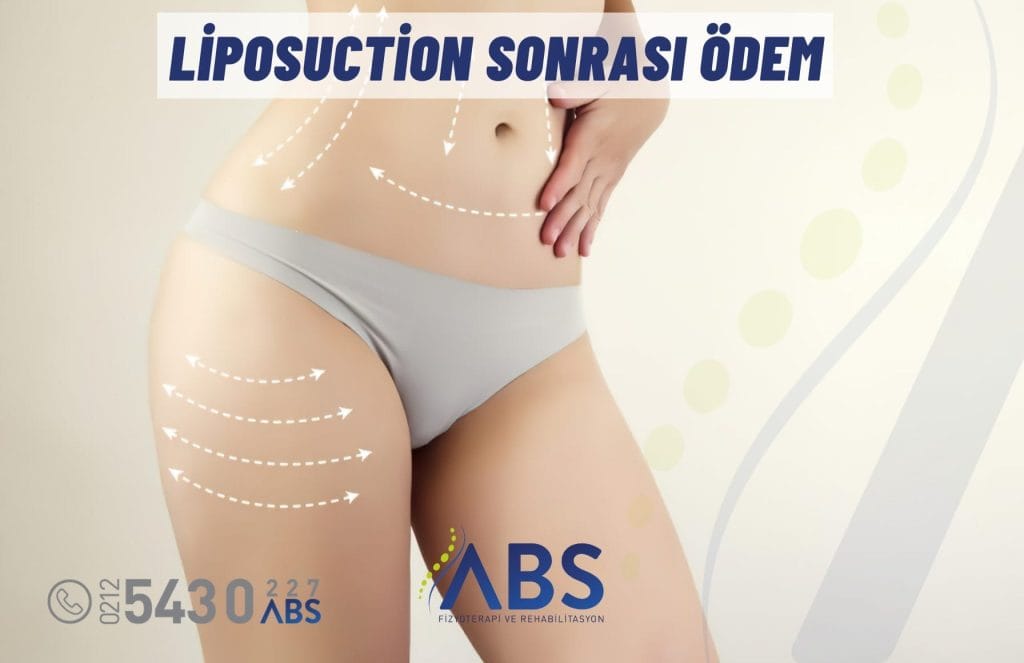 Liposuction Sonrası Ödem