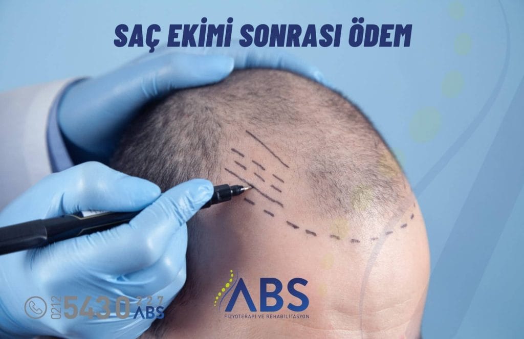 Saç Ekimi Sonrası Ödem