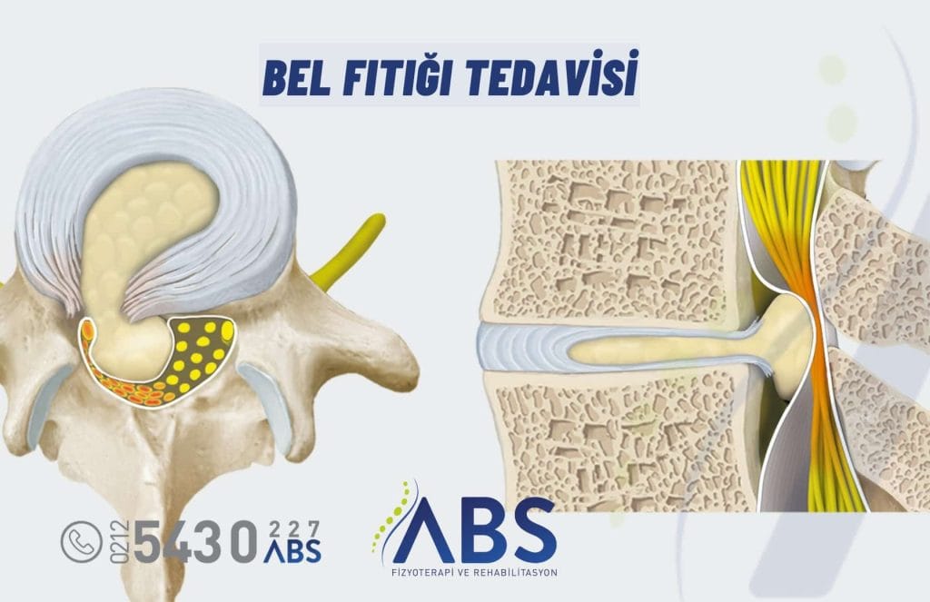 Bel Fıtığı Tedavisi