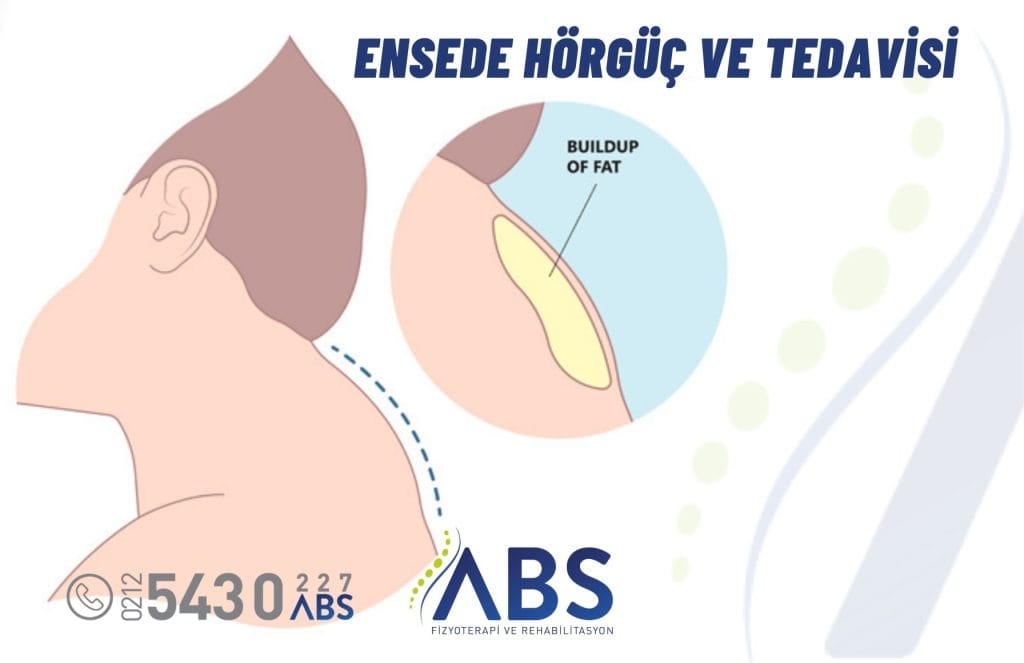 Ensede hörgüç (buffalo hump) – boyun ve sırt postür bozukluğu için fizyoterapi yaklaşımı