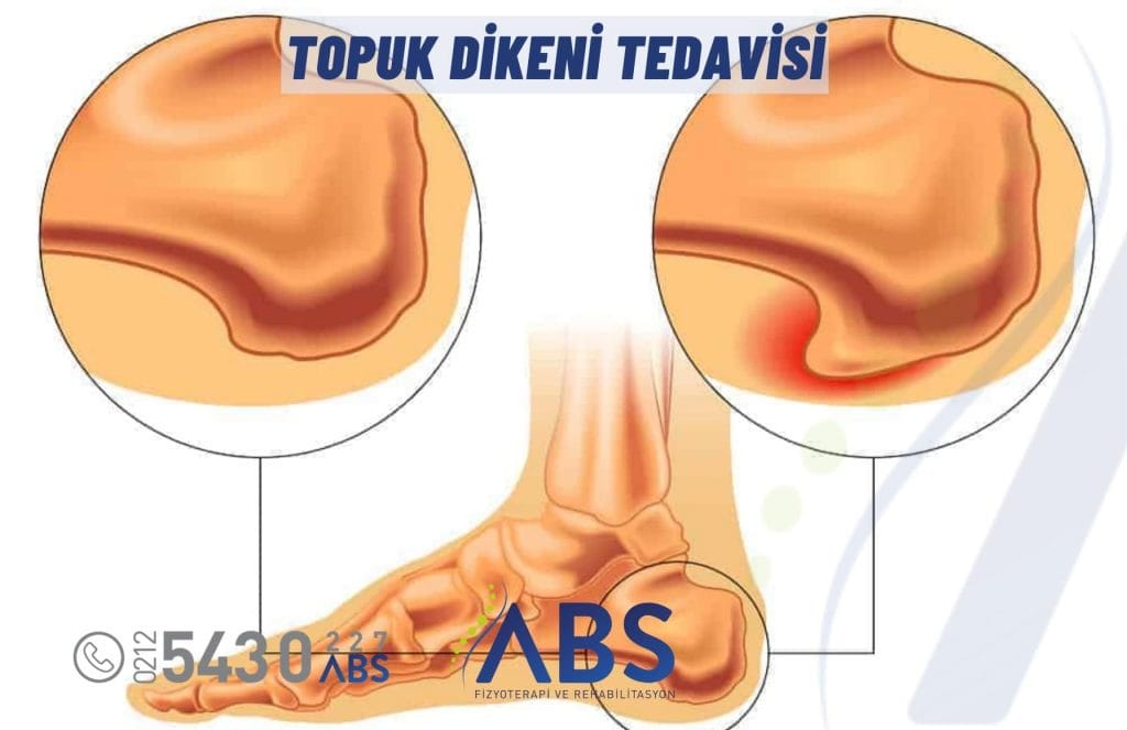Topuk Dikeni Tedavisi