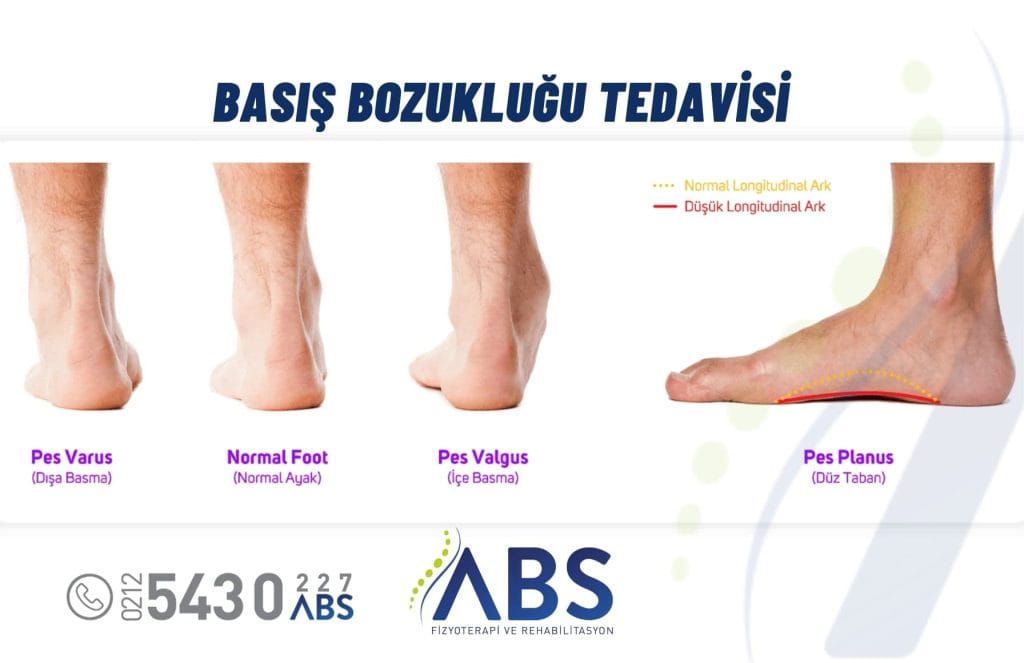 Basış Bozukluğu Tedavisi