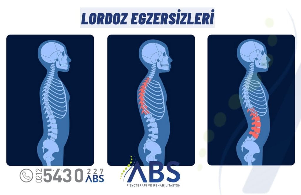 Lordoz Egzersizleri