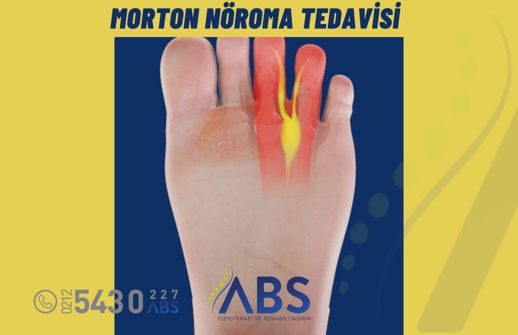 Morton Nöroma Tedavisi