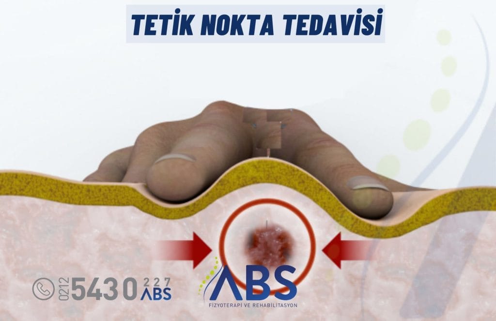 Tetik Nokta Tedavisi
