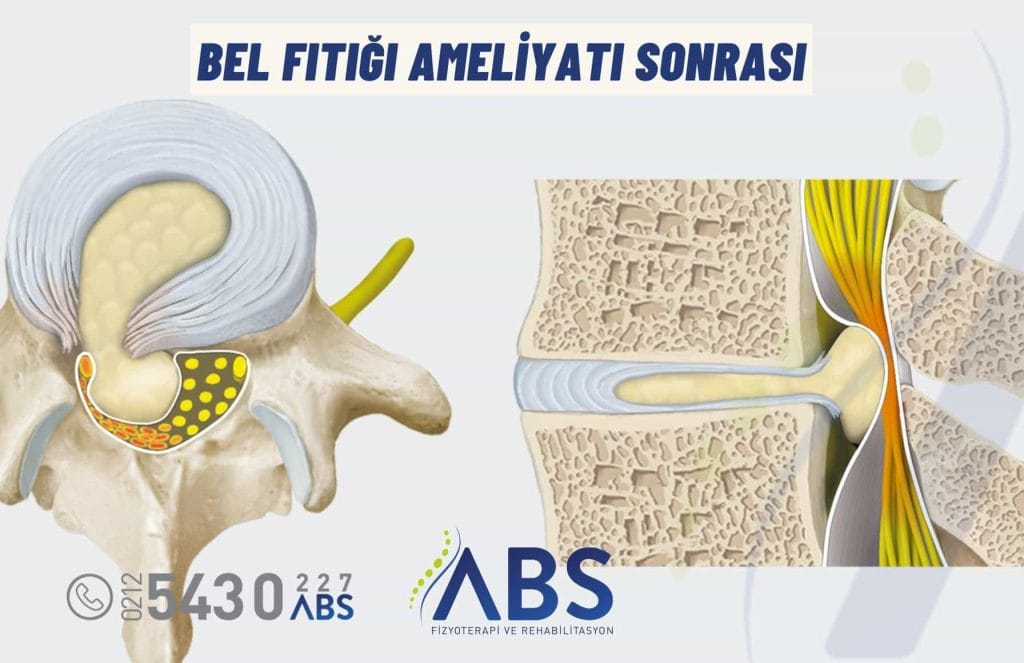 Bel Fıtığı Ameliyatı Sonrası