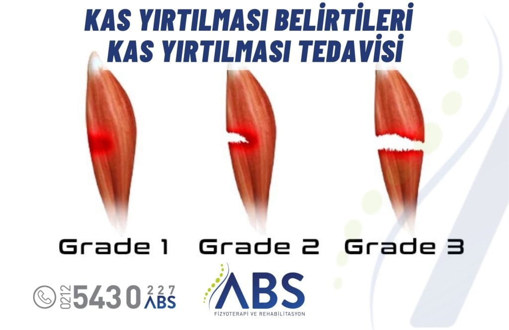 Kas Yırtılması Tedavisi