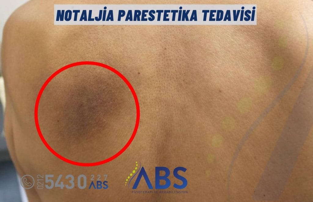 Notaljia Parestetika Tedavisi