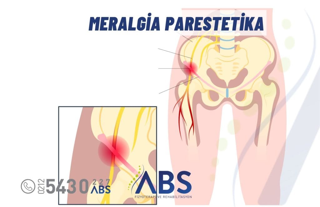 Meralgia Parestetika