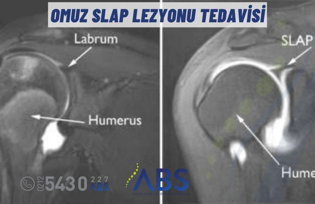 Omuz SLAP Lezyonu Tedavisi