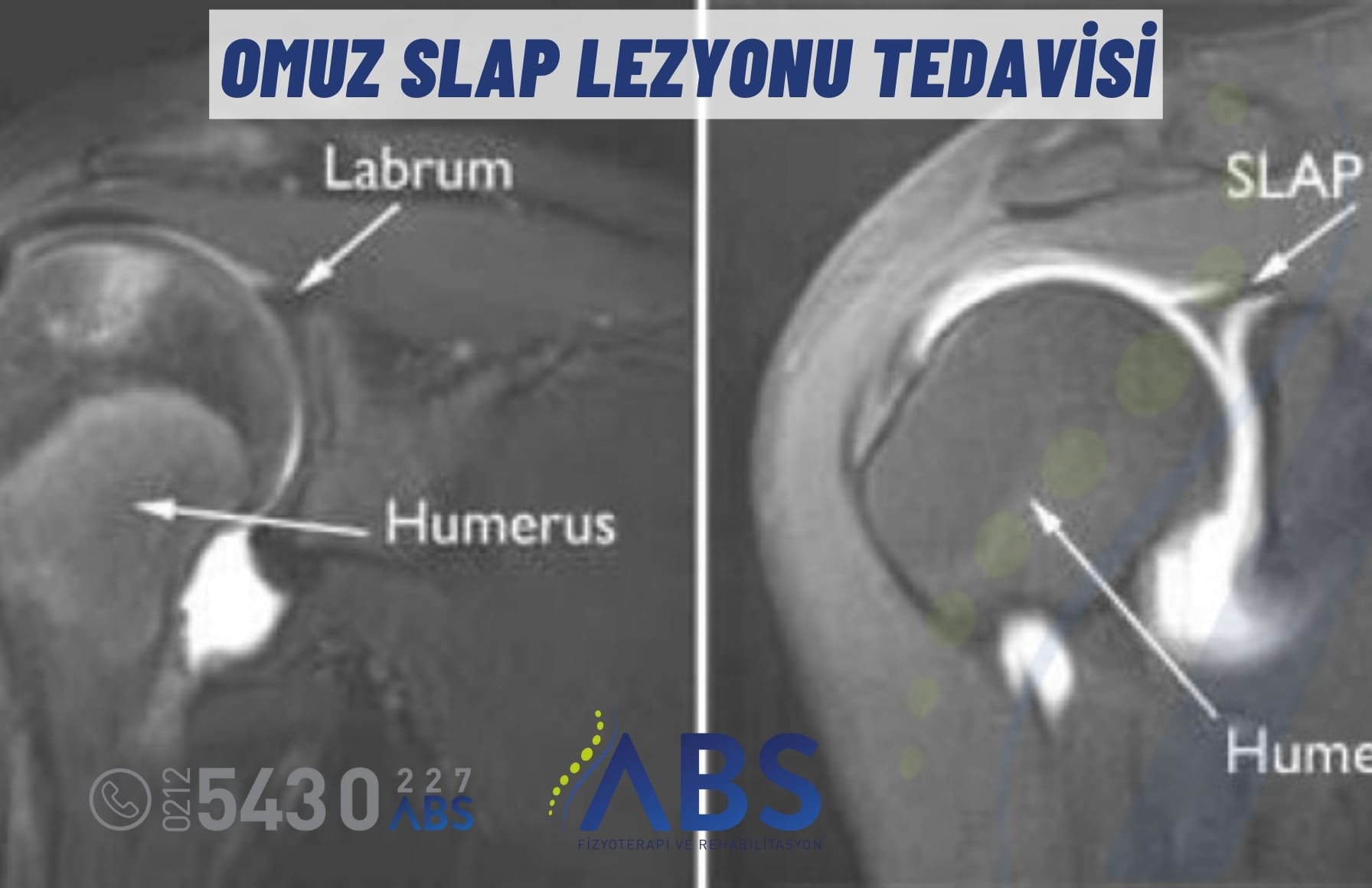 Omuz SLAP Lezyonu Tedavisi