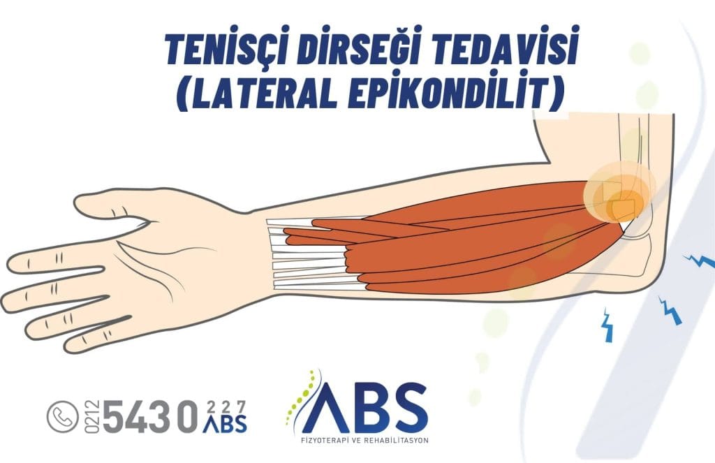 Tenisçi Dirseği Tedavisi