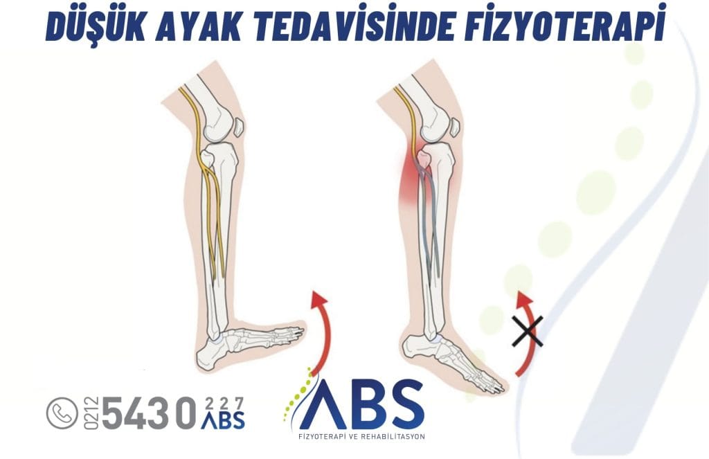 Düşük Ayak Tedavisi