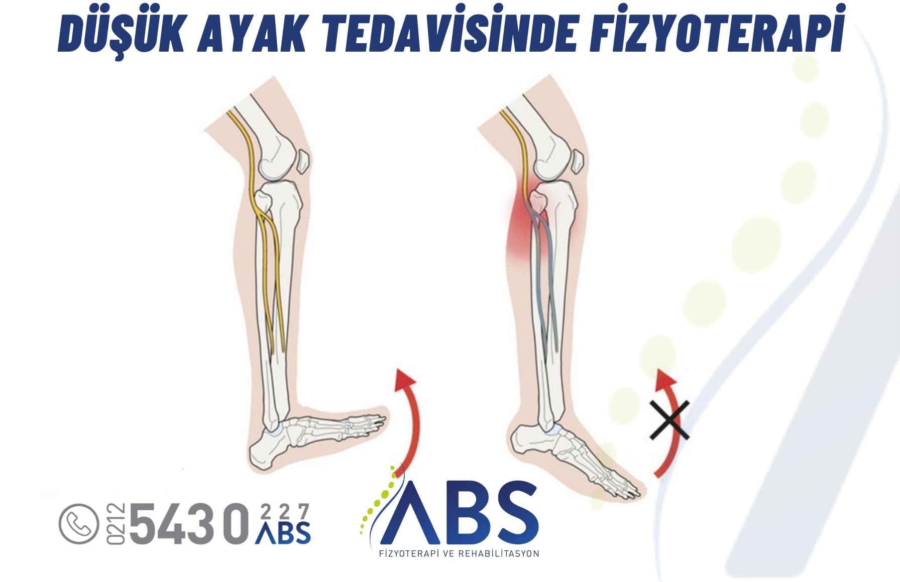 Düşük Ayak Tedavisi
