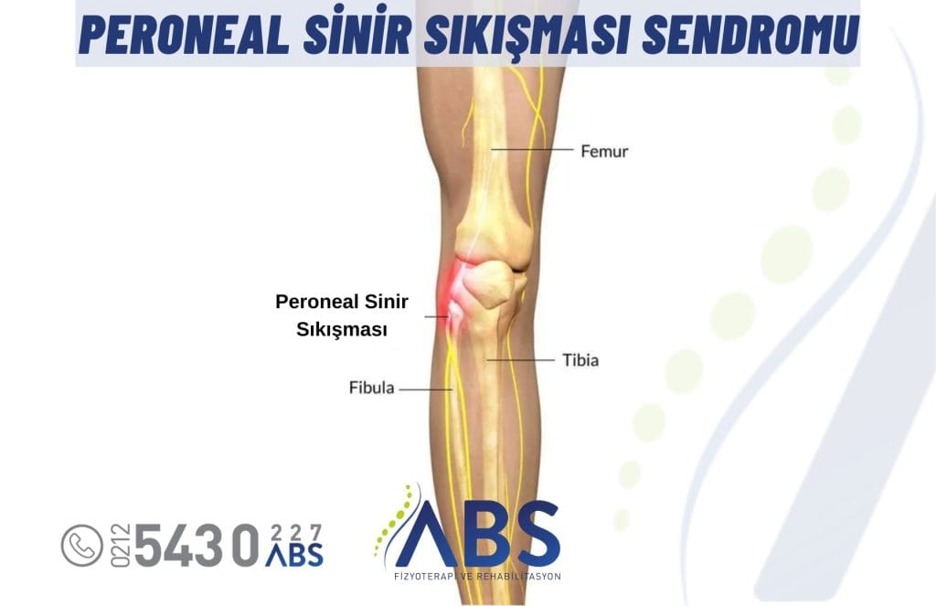 Peroneal Sinir Sıkışması Sendromu