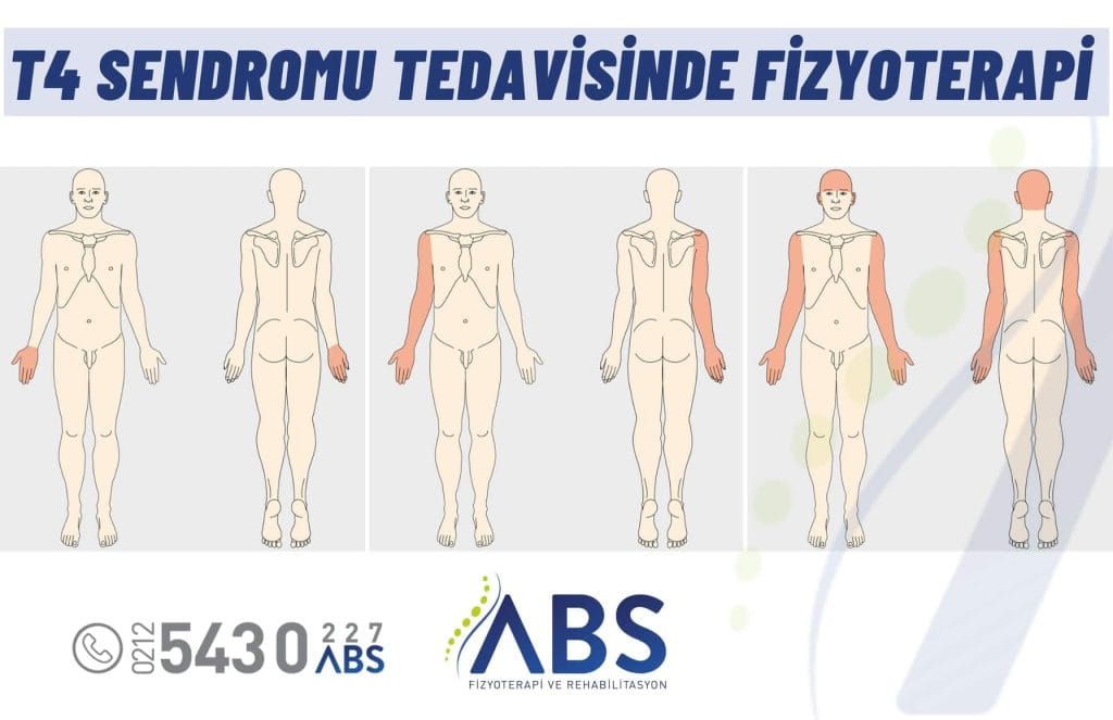 T4 Sendromu
