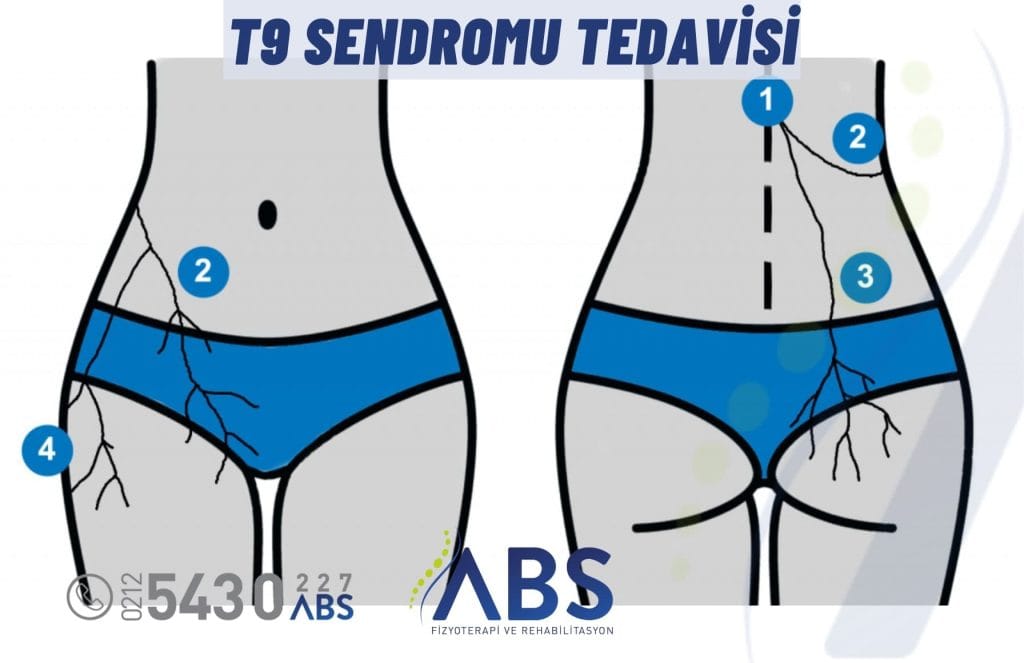 T9 Sendromu Tedavisi