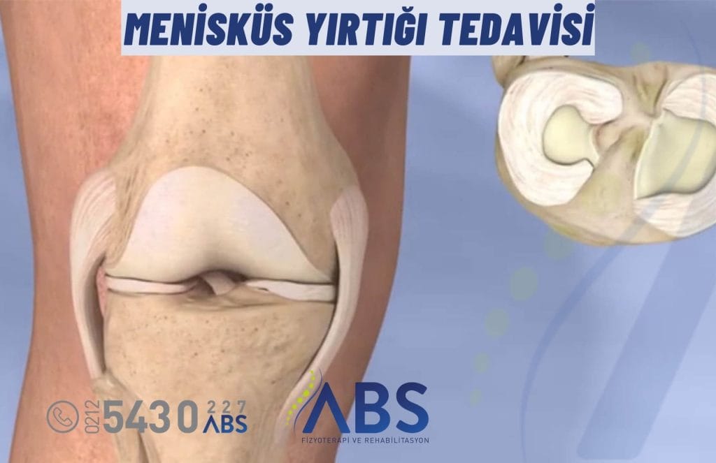 Menisküs Yırtığı Tedavisi