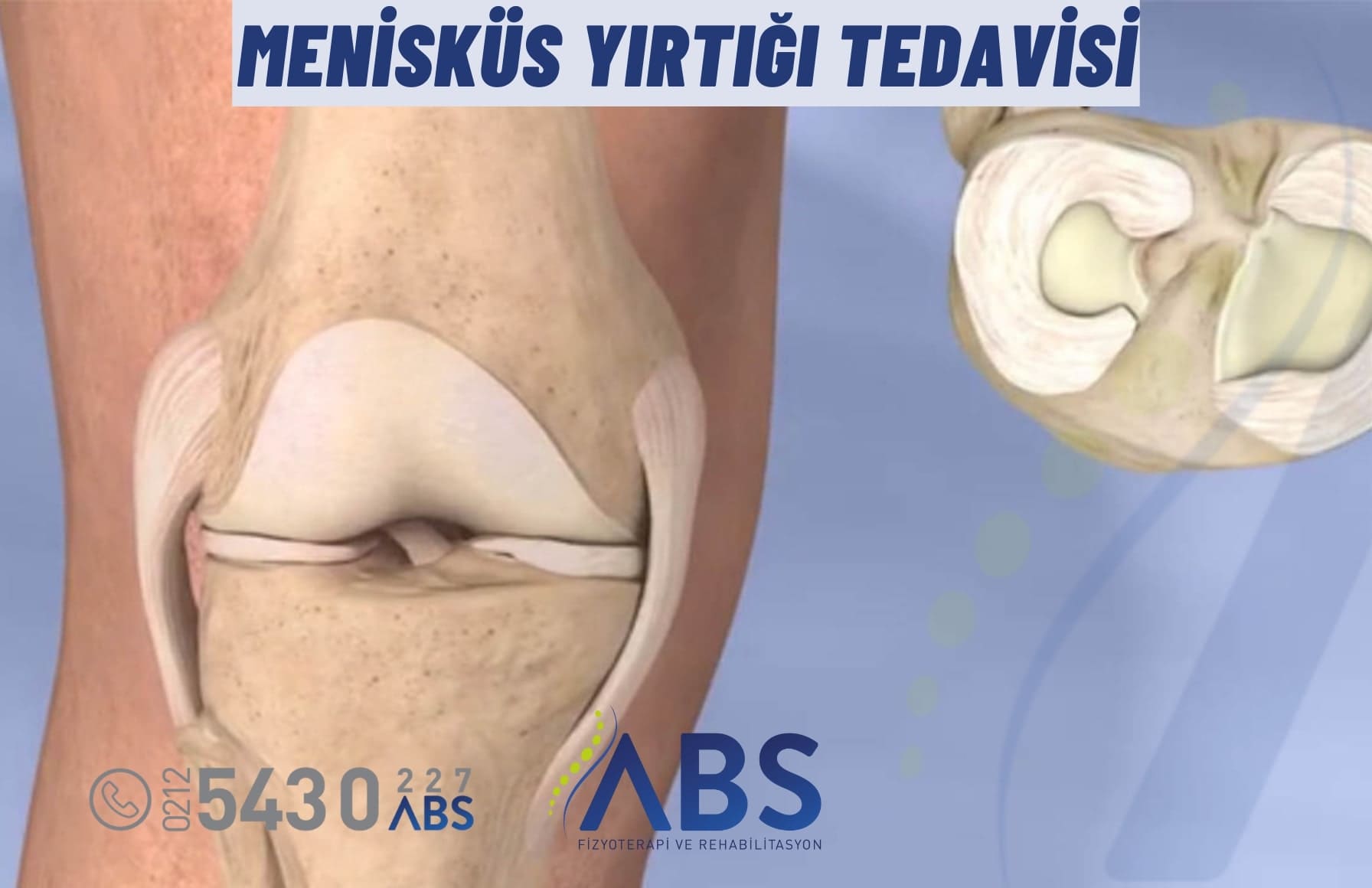 Menisküs Yırtığı Tedavisi