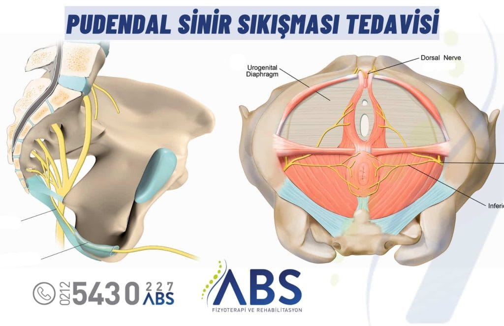 Pudendal Sinir Sıkışması Tedavisi