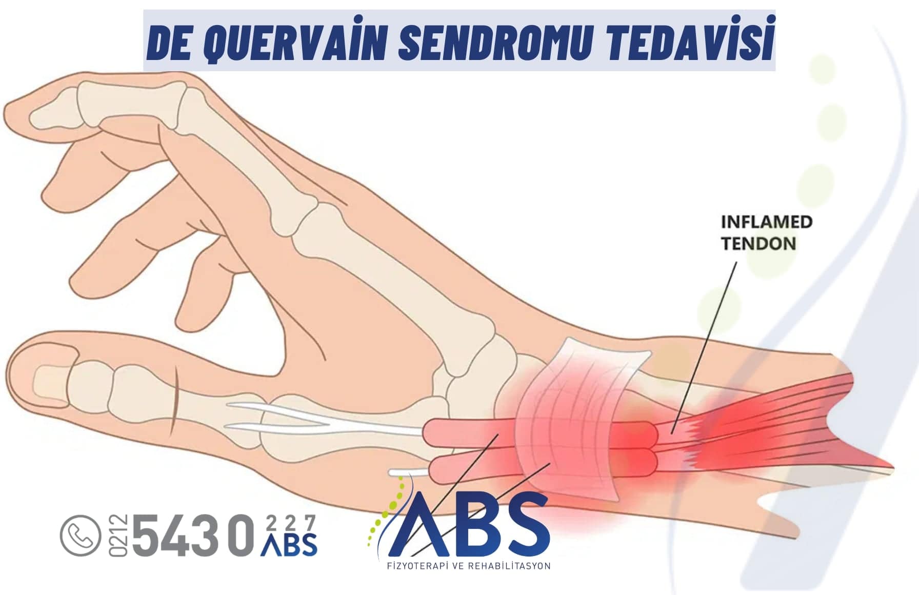 De Quervain Sendromu Tedavisi