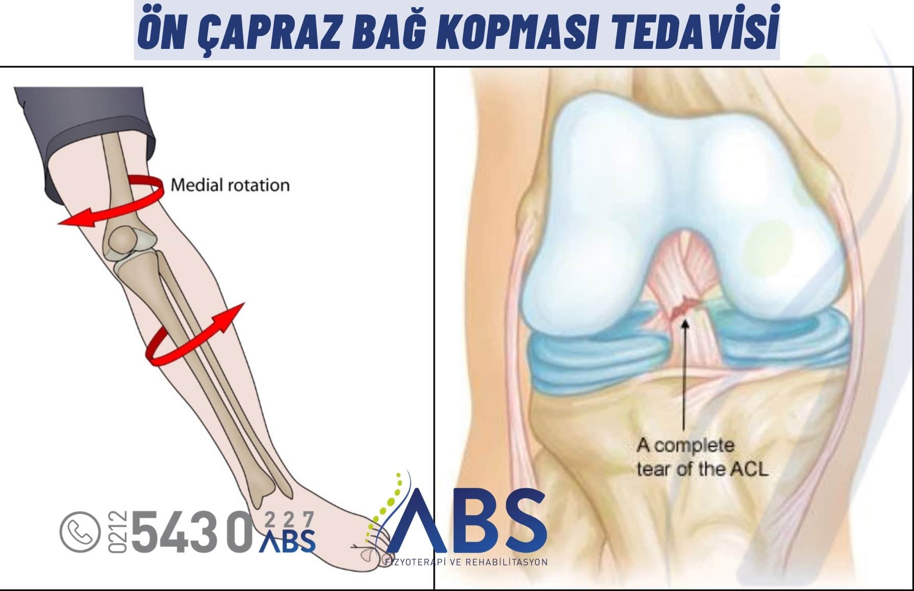 Ön Çapraz Bağ Kopması Tedavisi