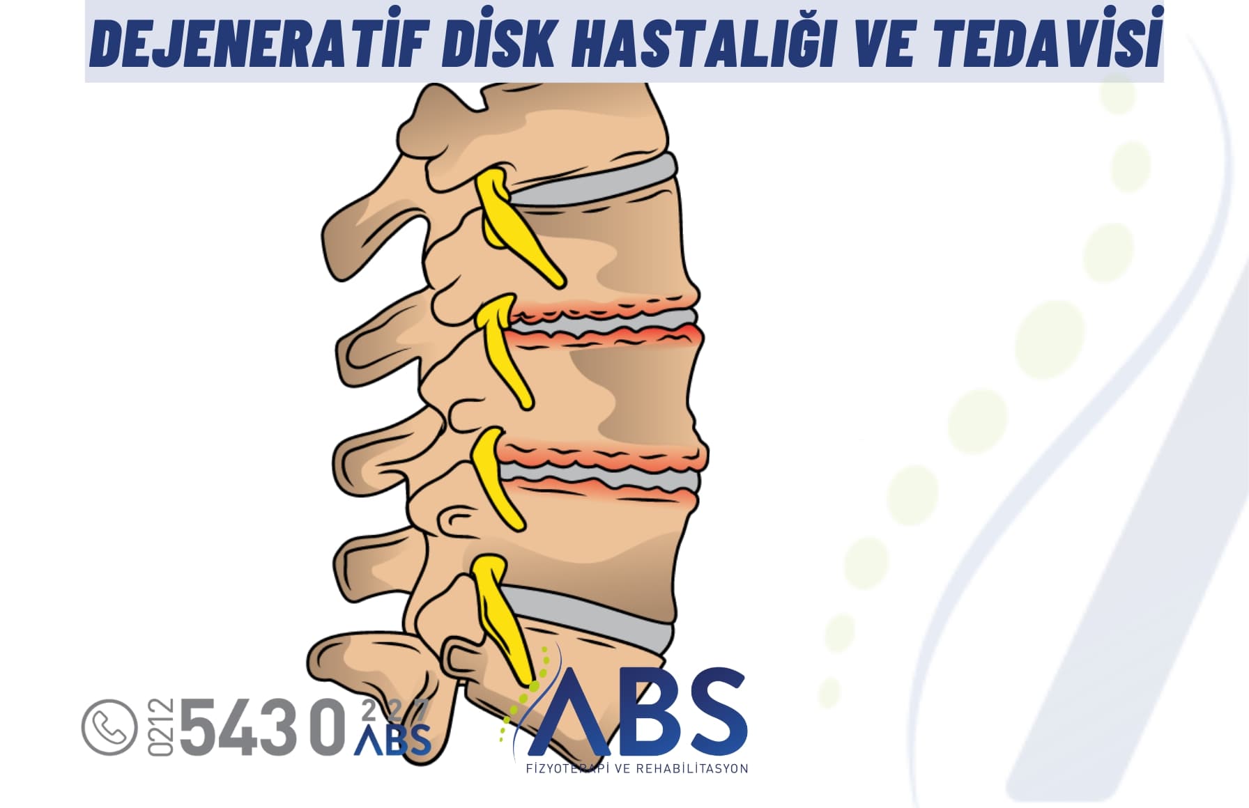 Dejeneratif Disk Hastalığı ve Tedavisi