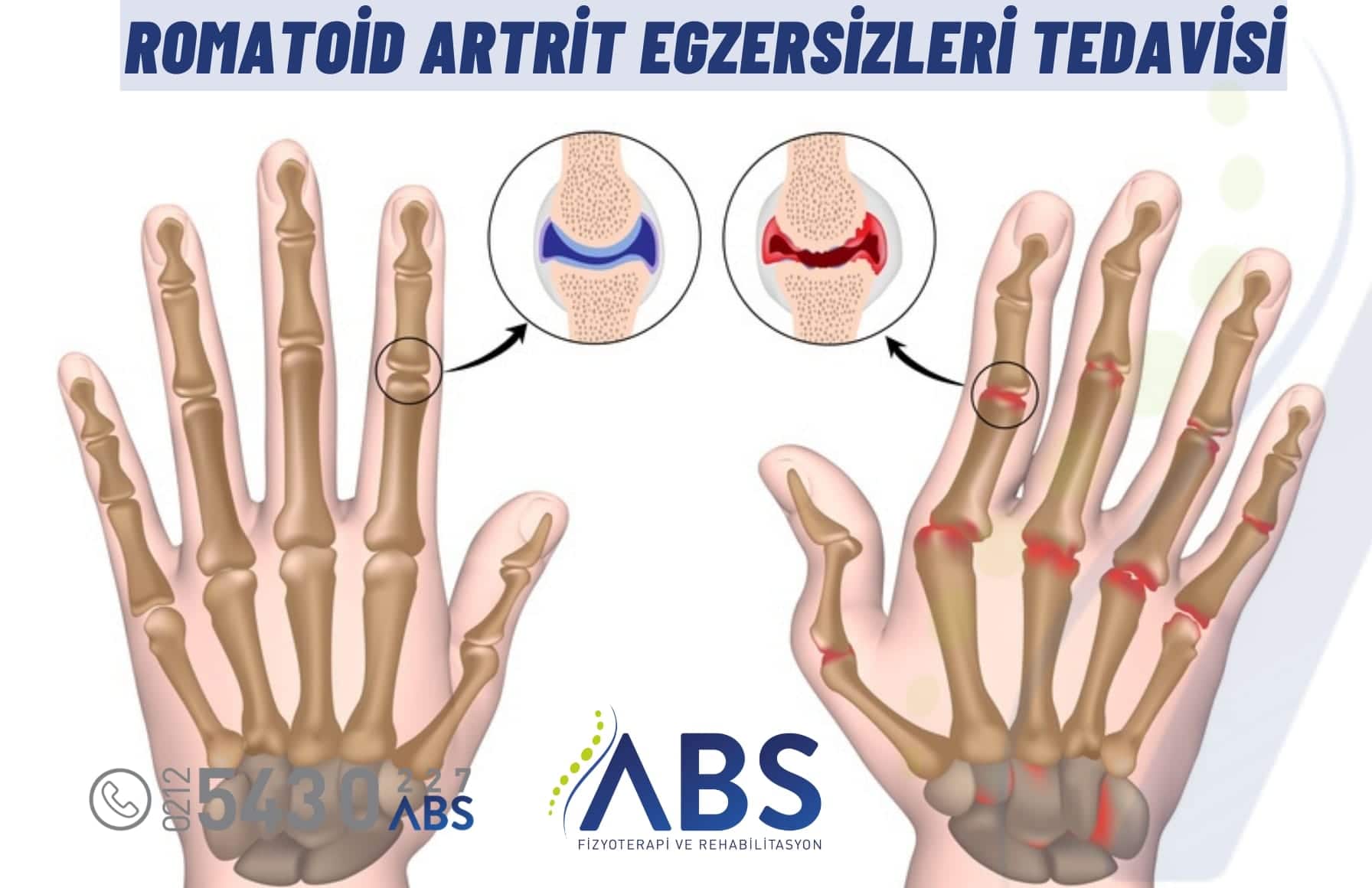 Romatoid Artrit Egzersizleri
