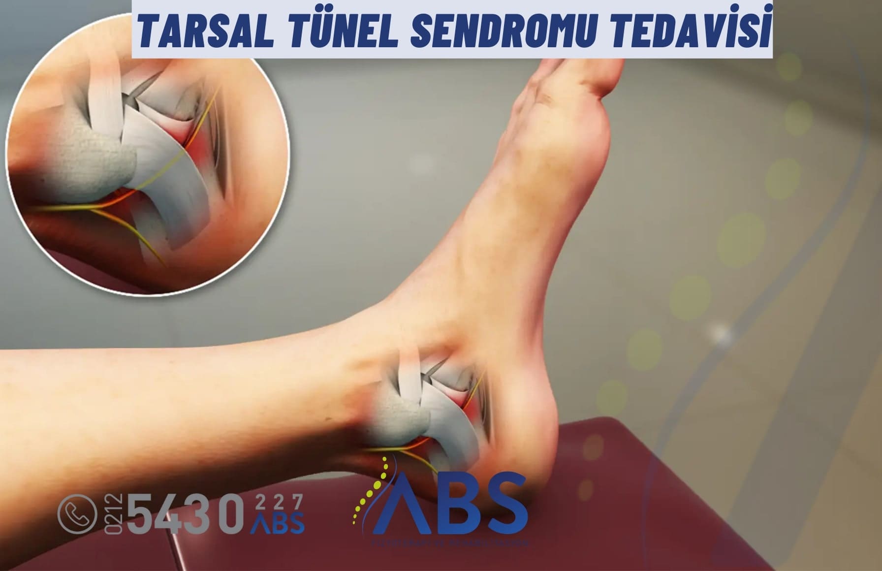 Tarsal Tünel Sendromu Tedavisi