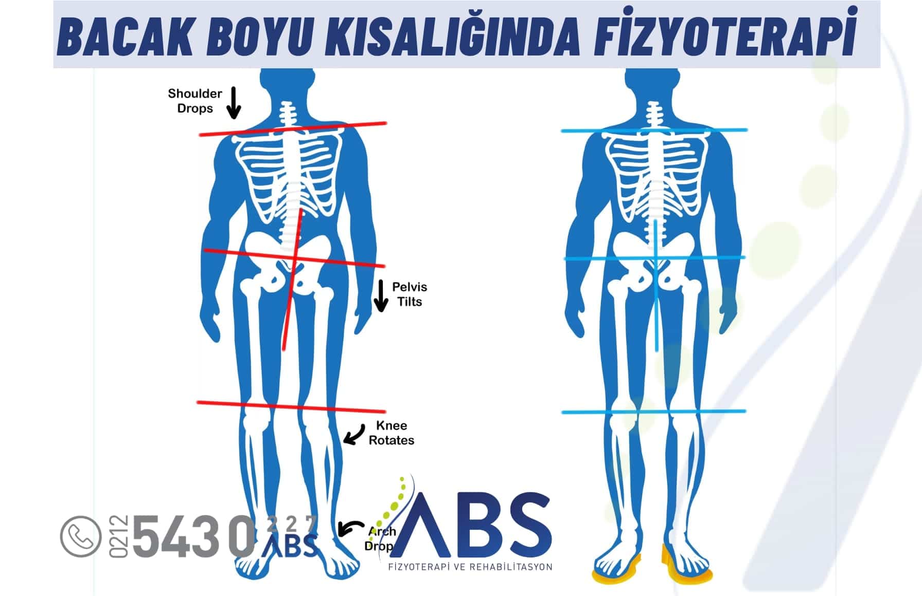 Bacak Boyu Kısalığında Fizyoterapi