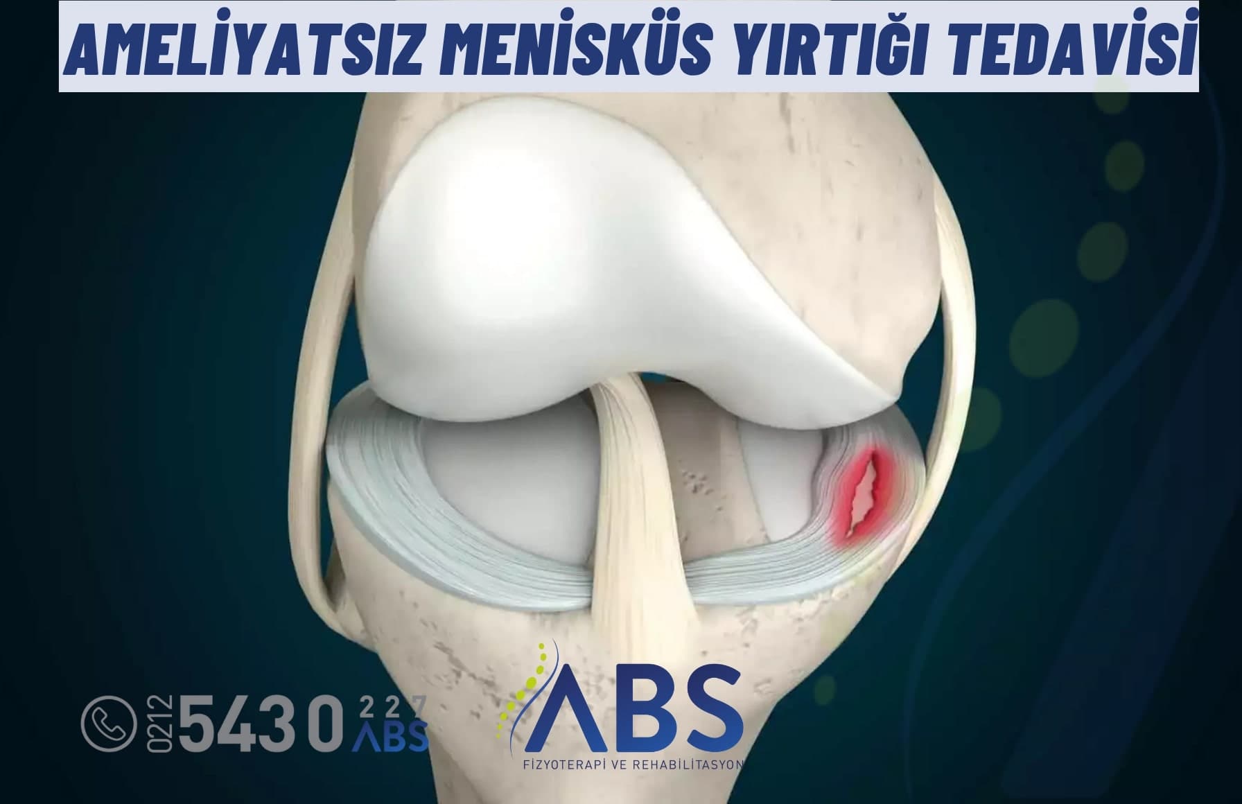 Ameliyatsız Menisküs Yırtığı Tedavisi