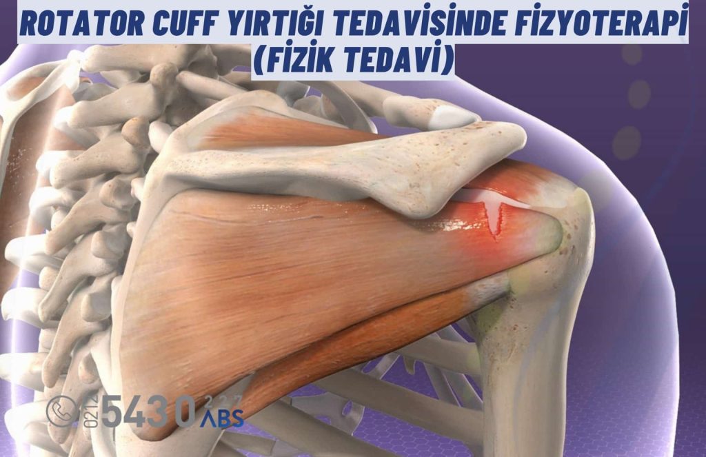 Rotator cuff yırtığı tedavisi, fizyoterapi ve rehabilitasyon yöntemleriyle yapılan ameliyatsız omuz tedavi süreci. Omuz kaslarını güçlendiren egzersiz ve manuel terapi yaklaşımlarıyla fonksiyonel iyileşme sağlanır.