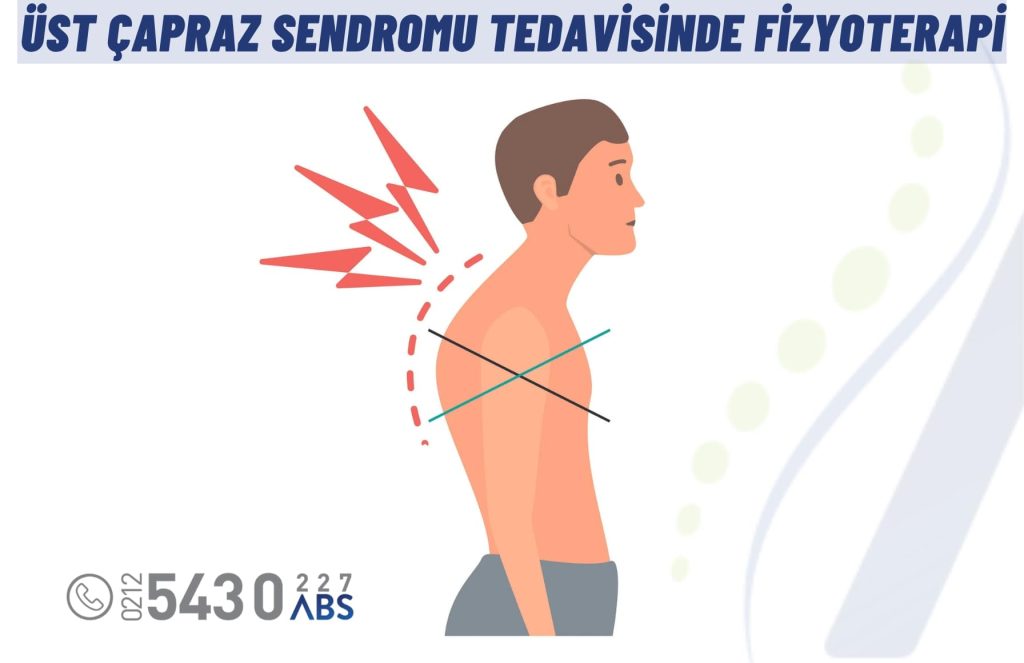 Üst çapraz sendromu tedavisinde fizyoterapi egzersizleri ve postür düzeltme uygulamaları.