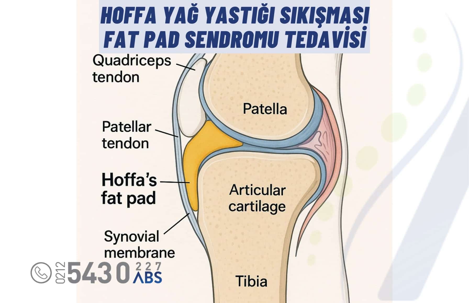 Fat Pad Sendromu (Hoffa Yağ Yastığı Sıkışması)