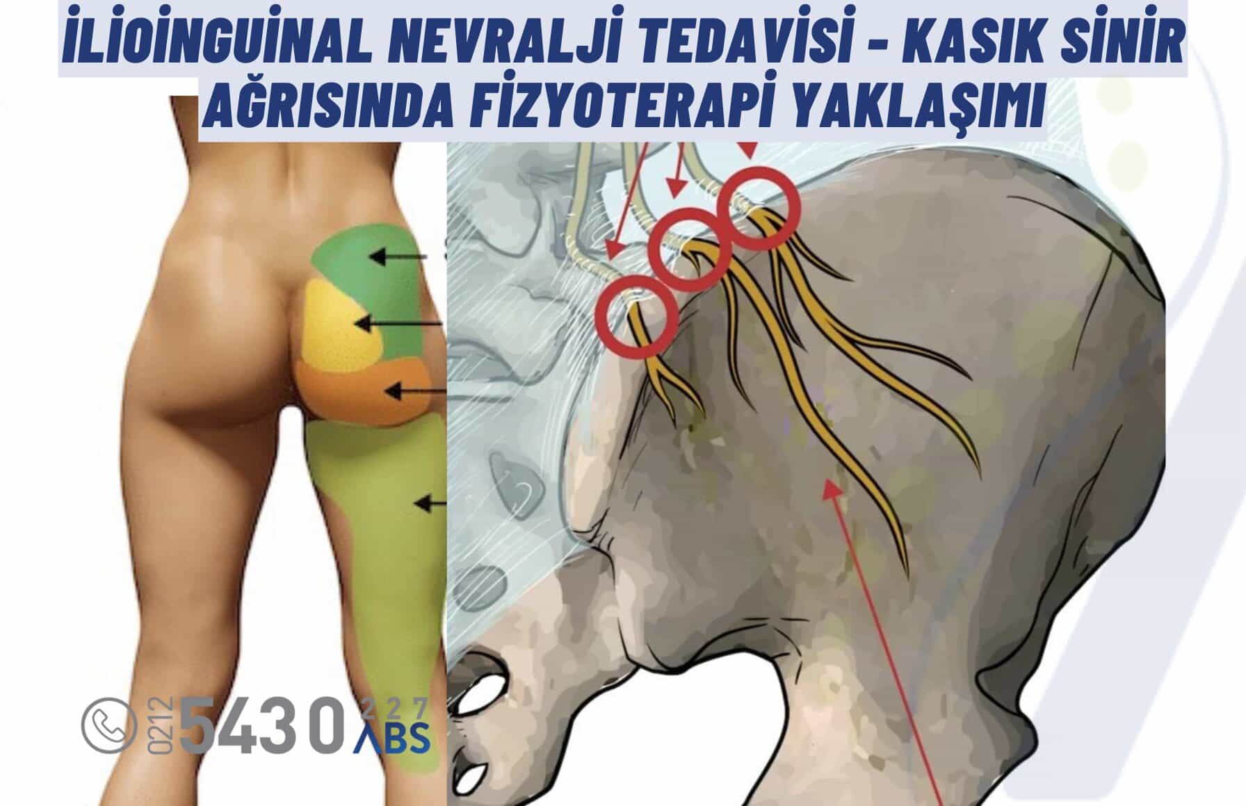 Kluneal Sinir Sıkışması: Bel Ağrısının Gözden Kaçan Nedeni