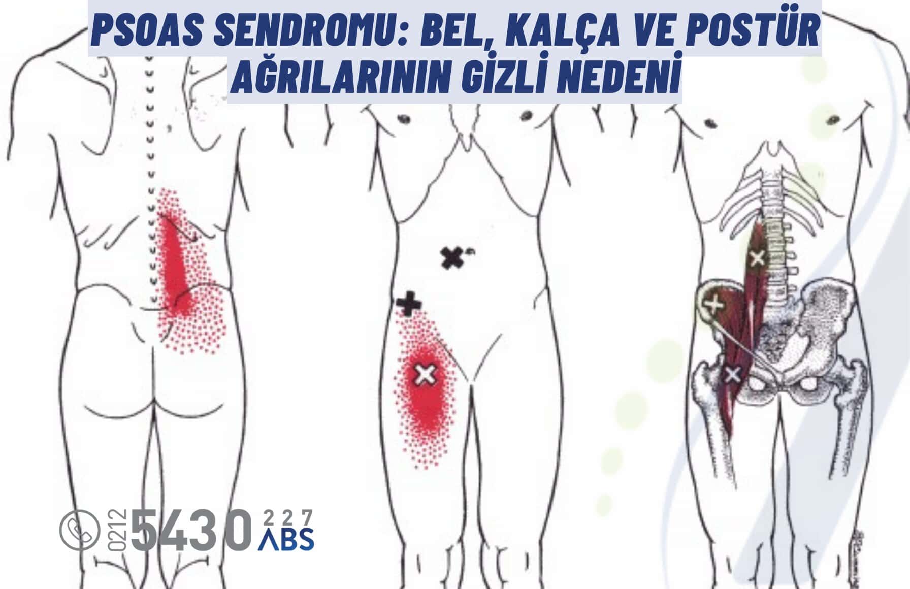 Psoas Sendromu: Bel, Kalça ve Postür Ağrılarının Gizli Nedeni
